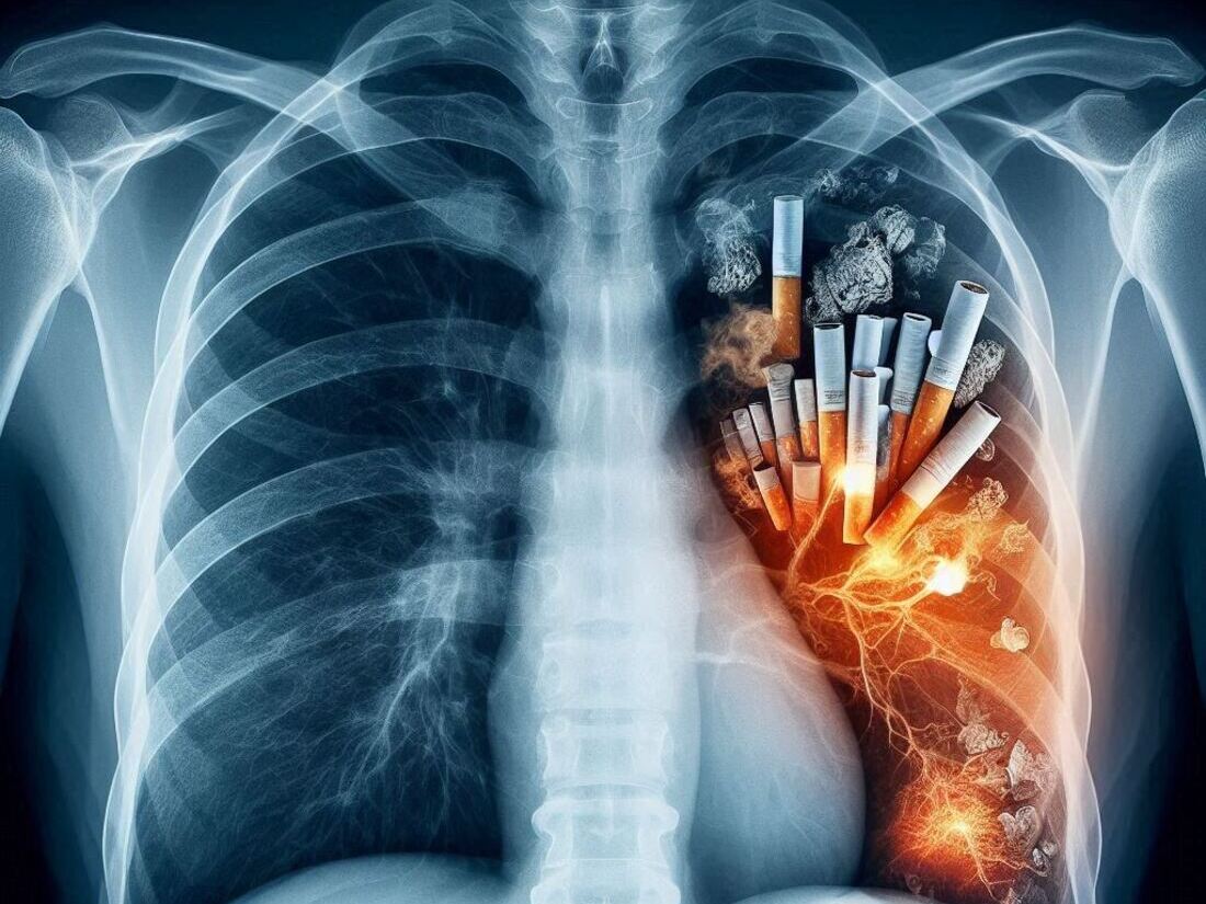 Comparison of healthy lungs vs. smoker's lungs